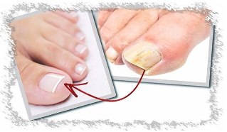 Przyczyny grzybicy paznokci