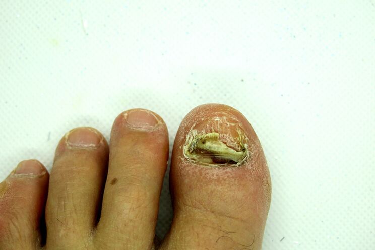 grzyb paznokci stóp - ciężki etap