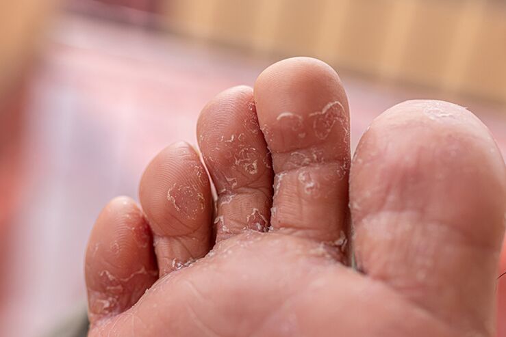 grzyb skóry palców - etap początkowy
