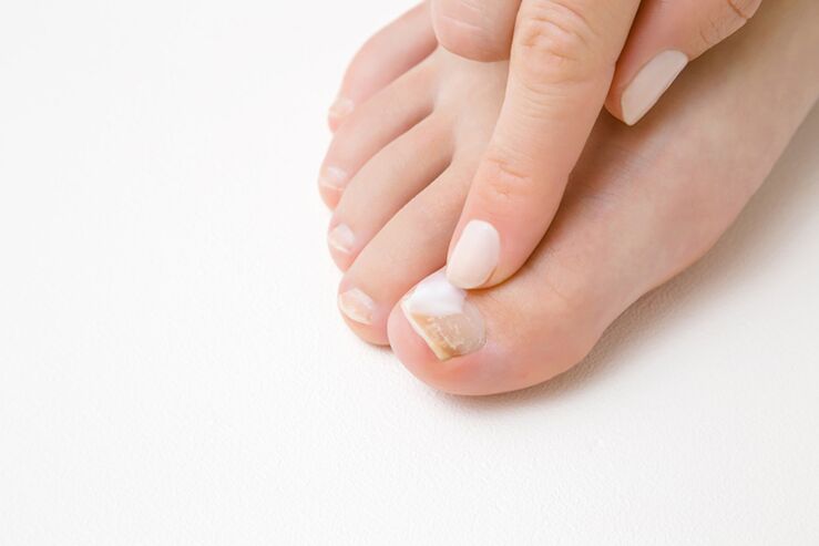 leczenie palców stóp maścią na grzyby