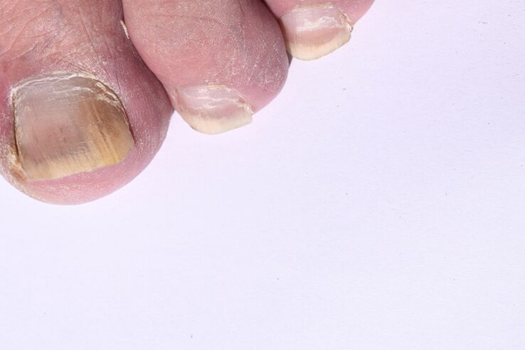 początkowy etap grzybicy paznokci u stóp