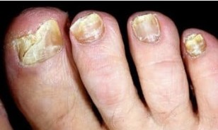 Ryzyko grzybicy paznokci