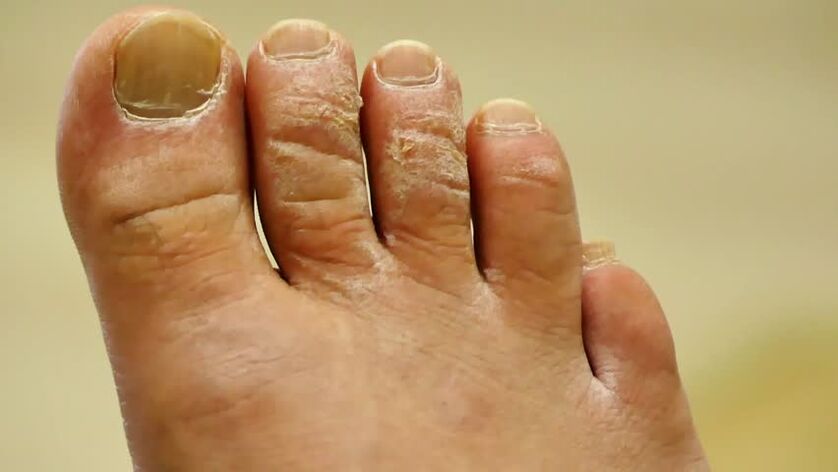 łuskowaty grzyb paznokci u stóp