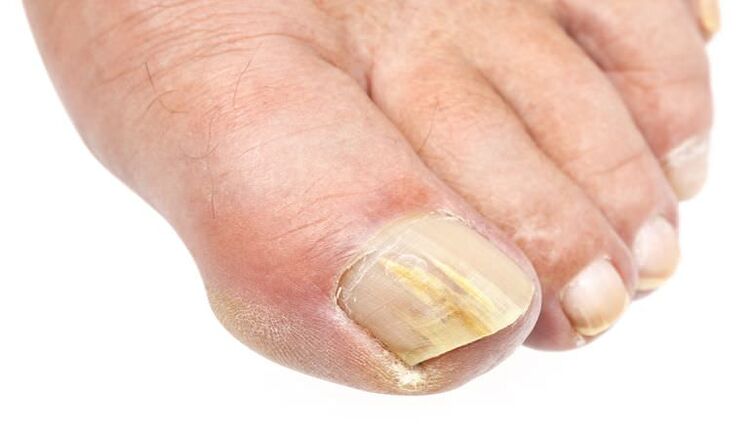 zewnętrzna zmiana paznokcia jest oznaką infekcji grzybiczej