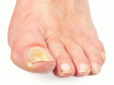 uszkodzenie paznokci z grzybem na stopach