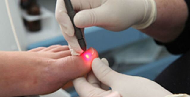Laseroterapia na grzybicę paznokci