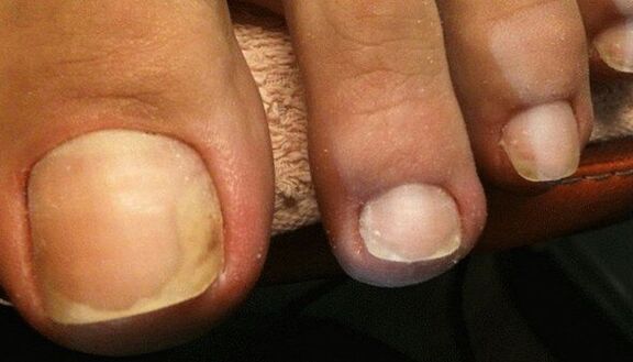 Oznaki początkowego stadium grzybicy paznokci