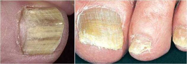 Zaawansowana forma grzybicy paznokci
