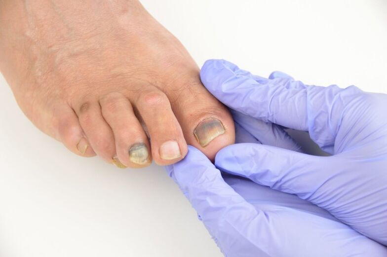 Badanie lekarskie paznokci dotkniętych grzybem
