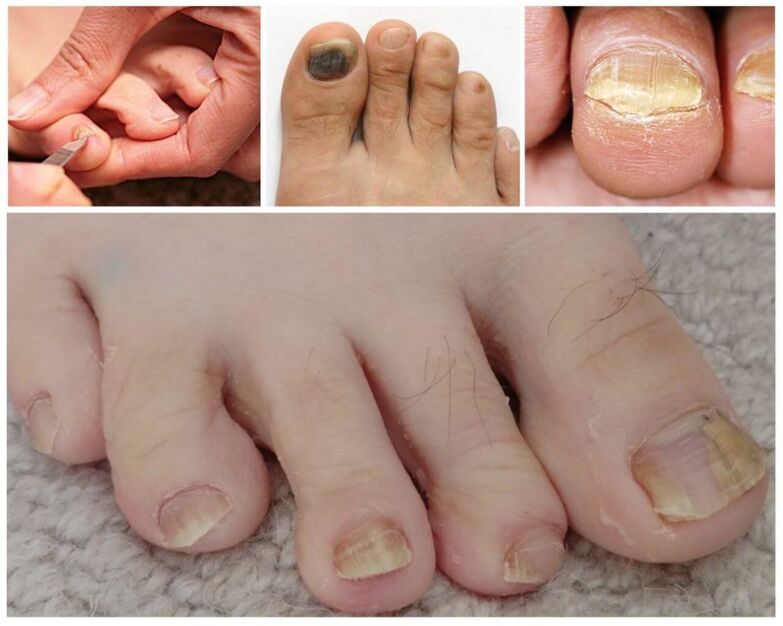 Objawy grzybicy paznokci