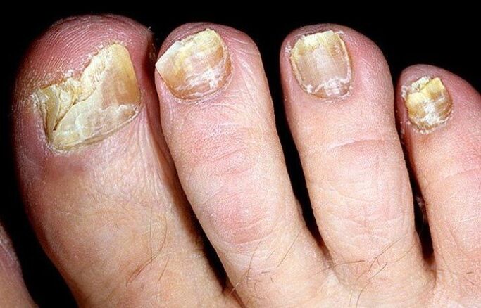 grzyb na paznokciach stóp