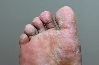 Ciężkie stadium grzybicy skóry palców na nogach